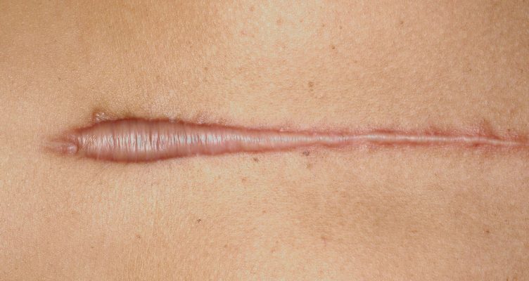 اسکار کلوئیدی